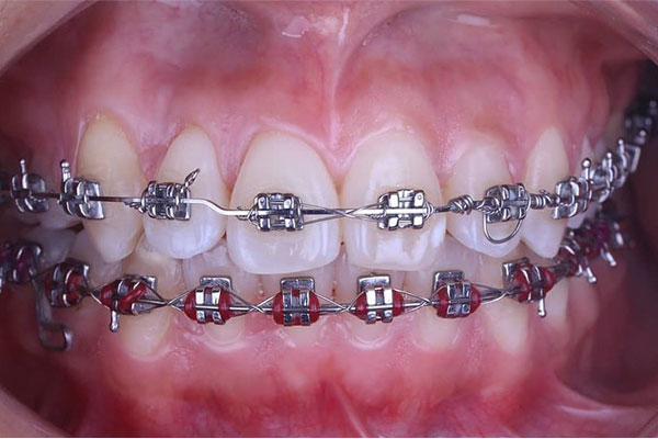 grd.service dental braces removal