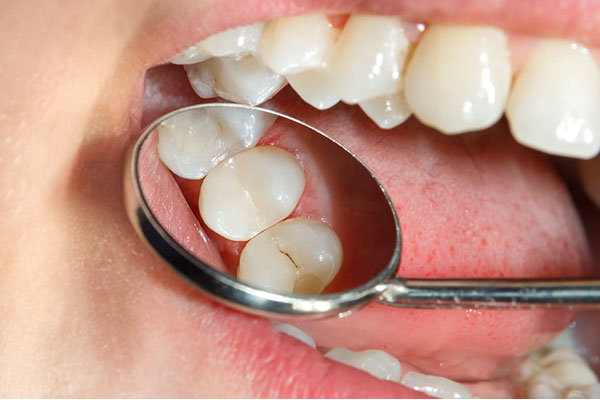 Grd.service Tooth Bonding