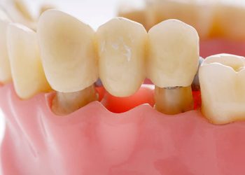 Dental Bridge 8 a patient education model of a dental bridge which is used to replace missing teeth