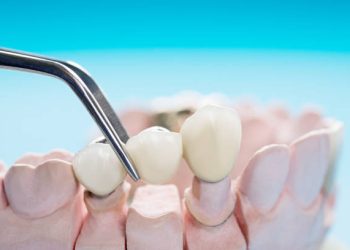 Dental Bridge 3 Closeup / Prosthodontics or Prosthetic / Teeth crown and bridge implant dentistry equipment and model express fix restoration.