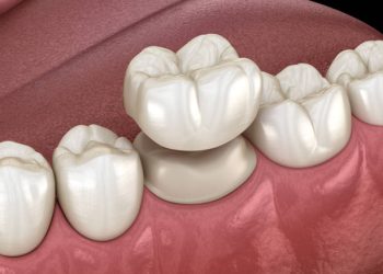 Dental Crown-Caps 1 Preparated molar tooth for dental crown placement. Medically accurate 3D illustration