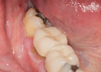 Dental Crown-Caps 4 Close up macro shot of interior of mouth and fillings and crowns on teeth