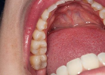 Dental Crown-Caps 6 Close up macro shot of interior of mouth and fillings and crowns on teeth