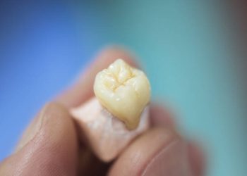 Dental Crown-Caps 3 Artificial tooth being done by a dental prosthesis specialist.