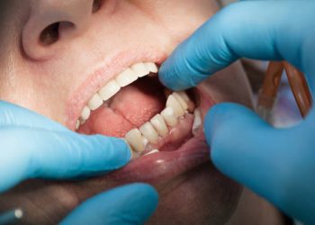 Dental Crown-Caps 9 Dental procedure