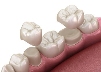 Dental Crown-Caps 7 Porcelain crowns placement over premolar and molar teeth. . Medically accurate 3D illustration