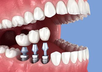 Dental Implants 1 Tooth crowns placement over 3 implants. Dental 3D illustration