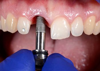 Dental Implants 3 Photo of procedure of dental implantation. Selective focus.