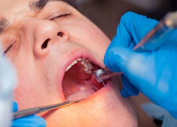 Tooth Extraction 9 Dentist treatment a patient's teeth in the dentist