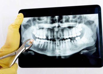Tooth Extraction 8 female dentist shows the patient his x-ray, the x-ray is of an old young male female and explains the procedure and treatment he will receive on his teeth, the x-ray shows the damage to the teeth.