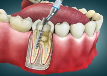 Root Canal 8 4D Root Canal Image