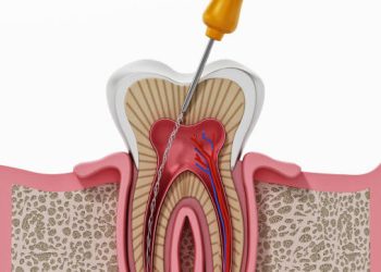 Root Canal 5 3D illustration of root canal treatment process.
