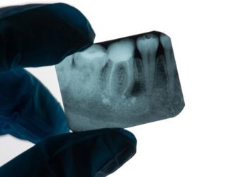 Root Canal 6 Periapical Dental Granuloma next to tooth root on an X-ray held by Dentist