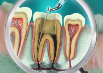 Root Canal 3 Advanced endodontic file in action...removing the infected enamel dentin and some parts of the pulp tissue.