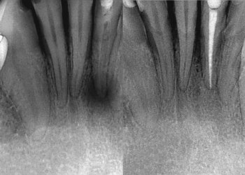 Root Canal 1 X-ray photos of before and after endo treatment protocol. Black and white photo.X-ray photos of before and after endo treatment protocol. Black and white photo.