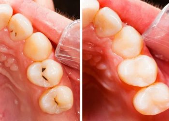 Tooth Bonding 1 Dental Fillings in San Jose, CA - Before and After Treatment