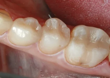 Tooth Bonding 9 TB (1)