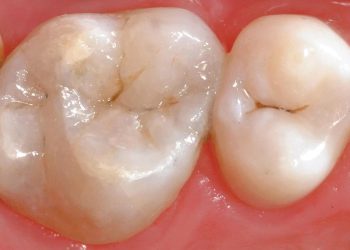 Tooth Bonding 7 TB (10)