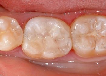 Tooth Bonding 5 TB (11)