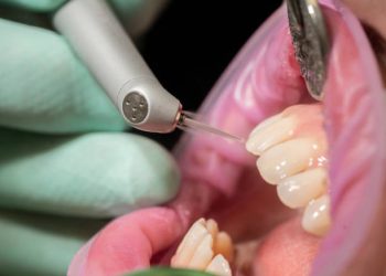 Tooth Bonding 10 Closeup of laser etching teeth procedure for Direct Bonding of
Orthodontic Appliance