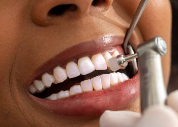 Teeth Cleaning 6 Close up view of a dentist polishing a patient's teeth with a dental drill, highlighting the precision and care in a dental clinic setting