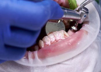 Teeth Cleaning 2 Close up of periodontist using dental polisher and mirror cleaning teeth of patient, with cheek retractor in mouth, polishing in dental clinic. Concept of professional dental hygiene