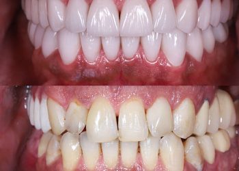 emax ceramic veneers before and after picture