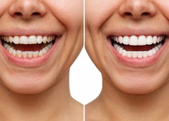 Cropped shot of a young caucasian smiling woman before and after veneers  installation isolated on a white background. Teeth whitening. Dentistry, dental treatment