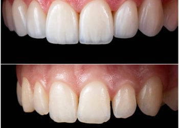 ceramic crowns and venners