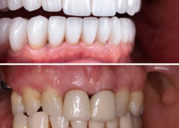 emax crowns and veneers