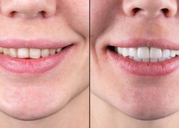 ceramic crowns and veneers before and after picture