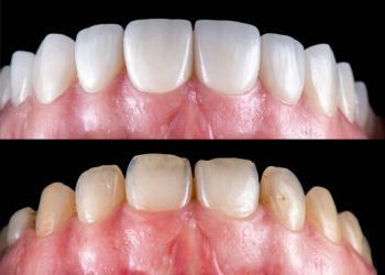 ceramic crowns and veneers before and after picture
