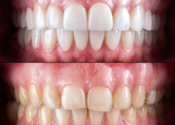 ceramic crowns and veneers before and after picture