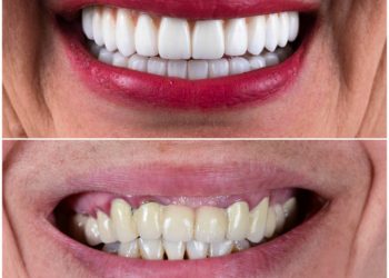 crowns veneers and implantsfull mouth rehabilitation by crowns veneers and implants