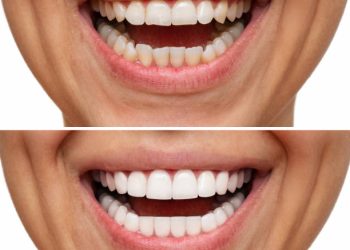Cropped shot of a young caucasian smiling woman before and after veneers installation. Teeth whitening. Dentistry, dental treatment