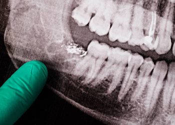Wisdom Teeth Removal 2 A doctor's finger in a green medical glove pointing to an x-ray with a lower wisdom tooth removed