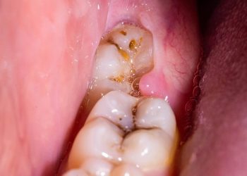 Wisdom Teeth Removal 7 WTE (11)