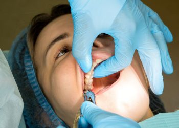 Wisdom Teeth Removal 8 WTE (12)