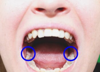 Wisdom Teeth Removal 1 Dental care concept. Carious wisdom teeth are surrounded by a blue circle for a clear indication of problem.