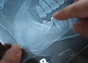 Wisdom Teeth Removal 6 Panoramic Xray of Impacted wisdom teeth.