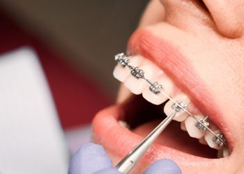 Dental Braces 2 blog-feature-103