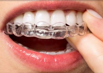 Invisalign 1 Edt Service Invisalign 11