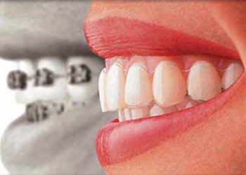 Invisalign 2 Edt Service Invisalign 13