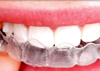 Invisalign 4 Edt Service Invisalign 17