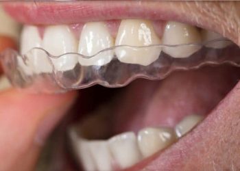 Invisalign 5 Edt Service Invisalign 21