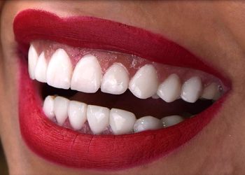 Smile Design 1 Edt Service Smile 17
