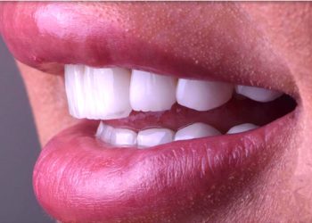 Smile Design 11 Edt Service Smile 23