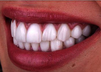 Smile Design 10 Edt Service Smile 25