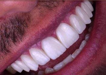 Smile Design 8 Edt Service Smile 31