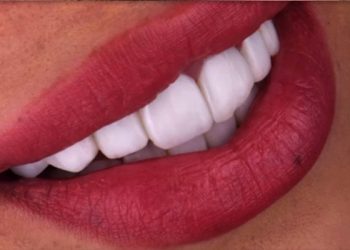 Smile Design 7 Edt Service Smile 33